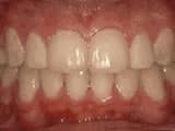 crowding of teeth after Bailey Orthodontics