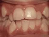 Bailey Orthodontics crowding of teeth before