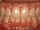 deep overbite after Bailey Orthodontics