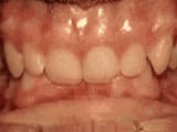Bailey Orthodontics deep overbite before