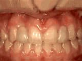missing lateral incisors after Bailey Orthodontics