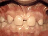 Bailey Orthodontics missing lateral incisors before