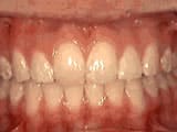 Overbite after Bailey Orthodontics
