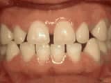 Bailey Orthodontics spacing of teeth before
