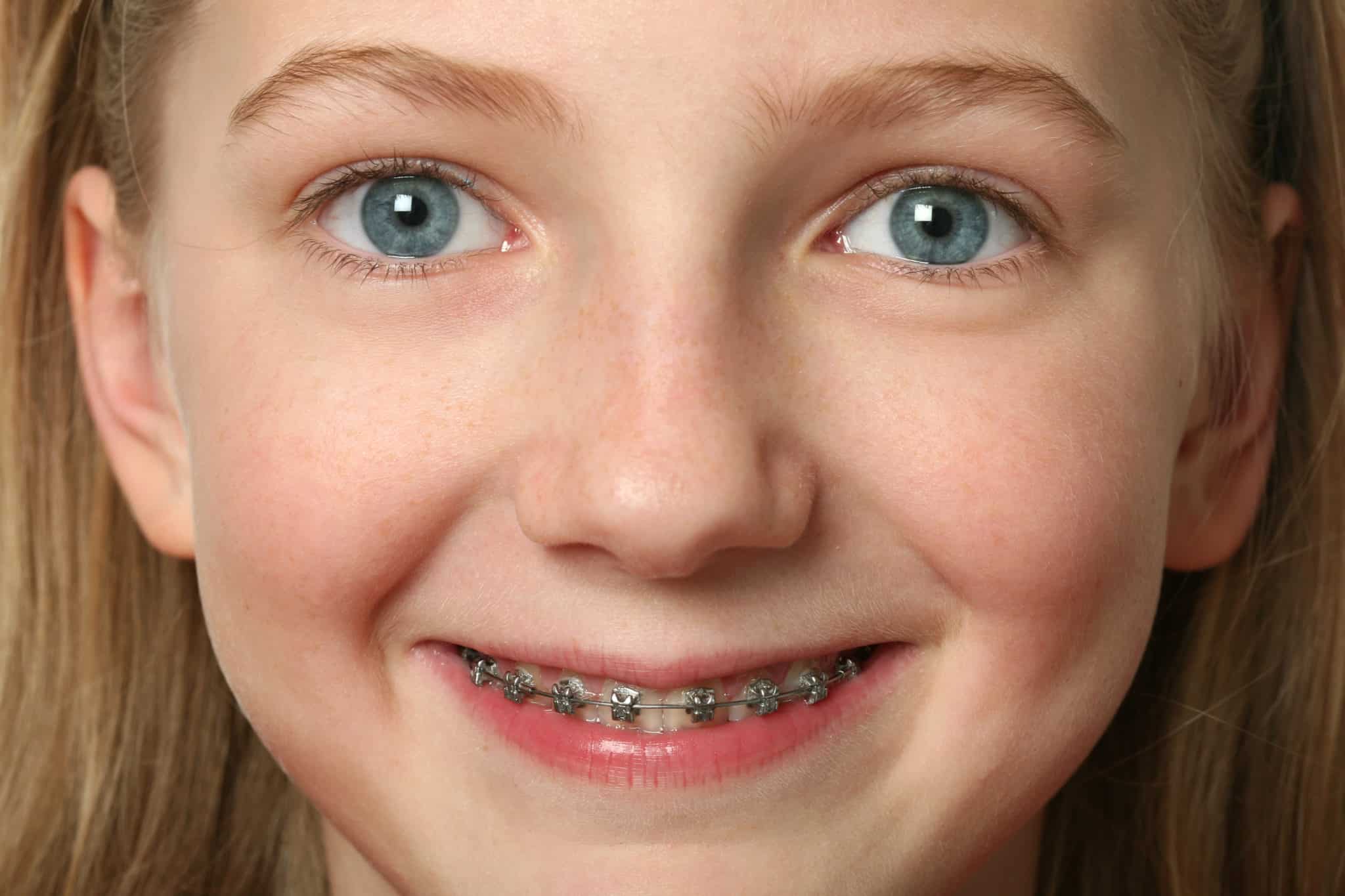 Is Two Phase Orthodontic Treatment Necessary Bailey Orthodontics 8552