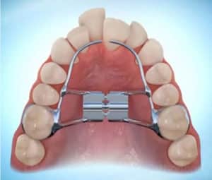 Palatal Expander Palatal Expander Bailey Orthodontics expander