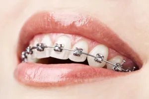 Adult braces