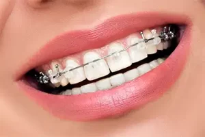 Self-Ligating Braces Self-Ligating Braces