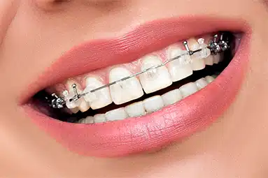 Self-Ligating Brackets