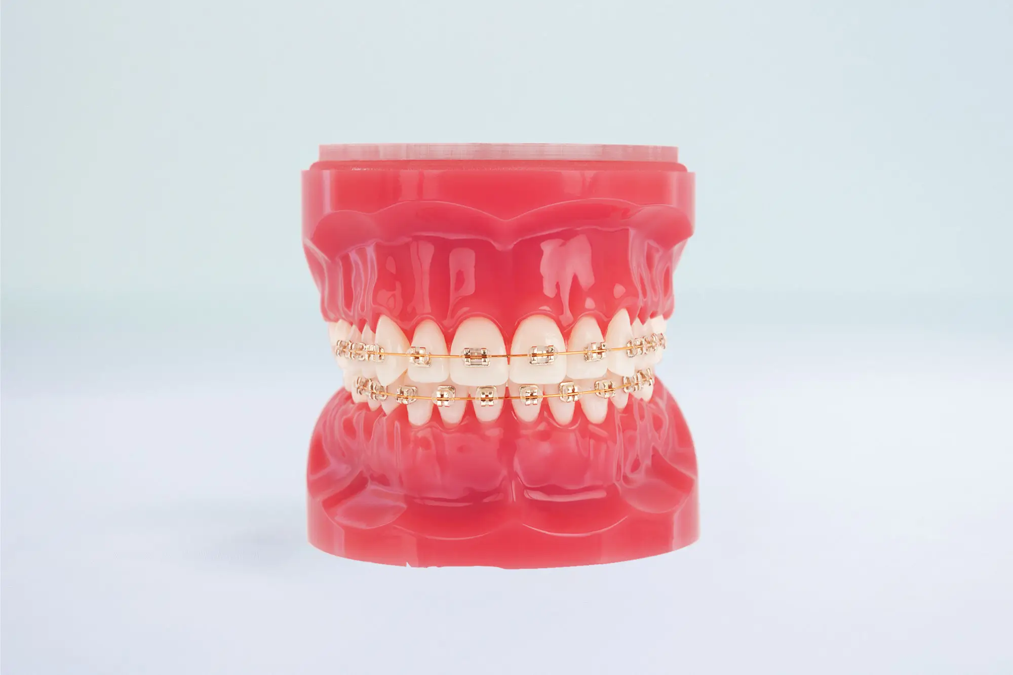 Iconix Esthetic Braces