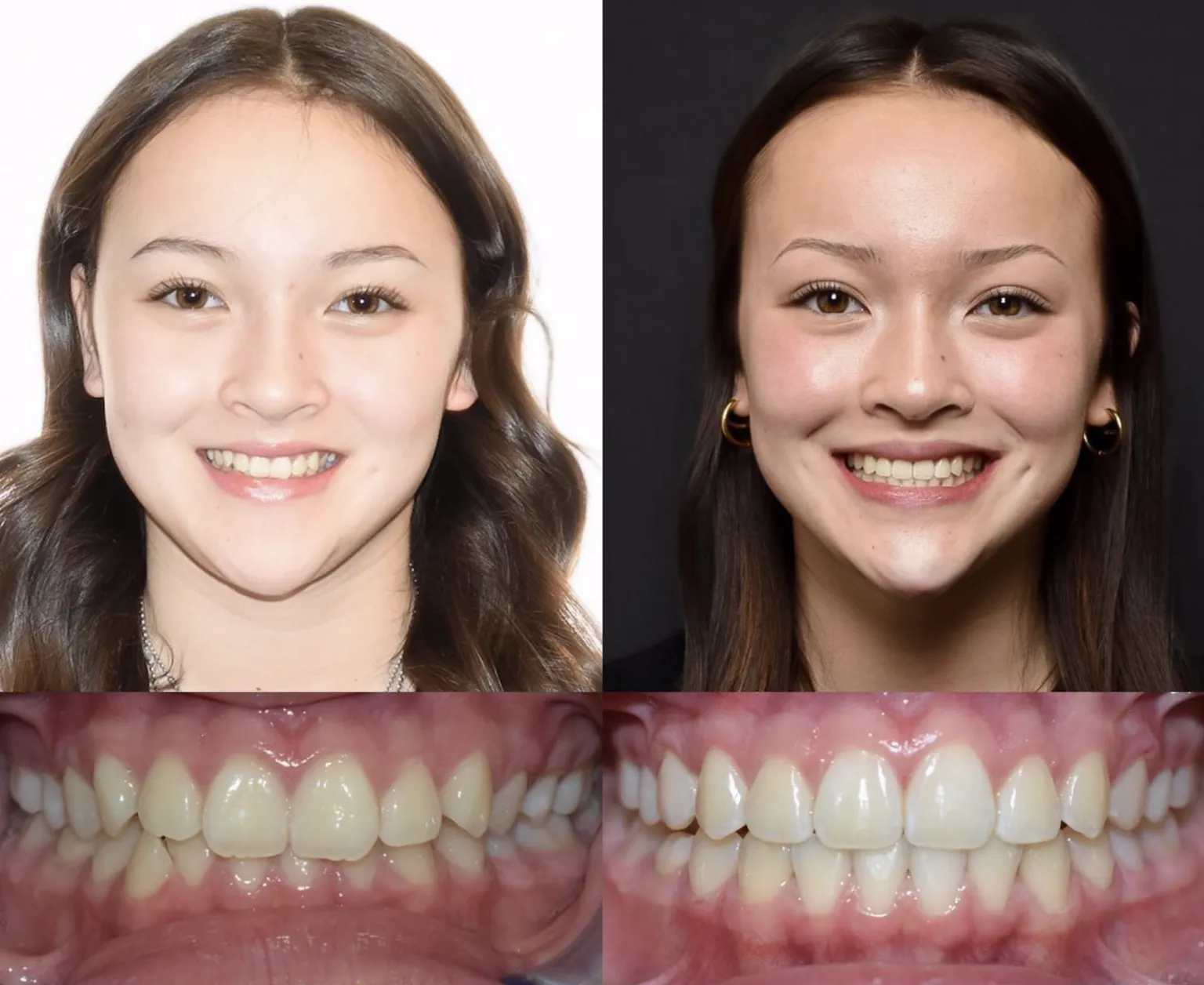 Young Adult Woman Orthodontics Before and after