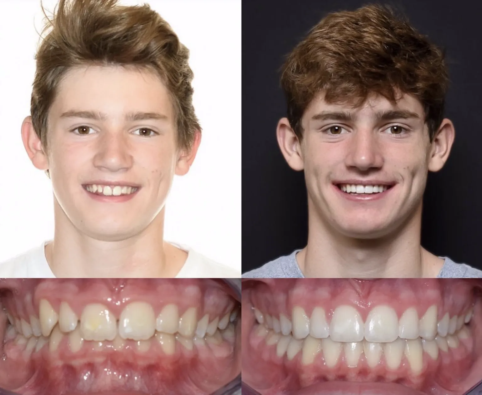 Young Adult Man Orthodontics Before and after
