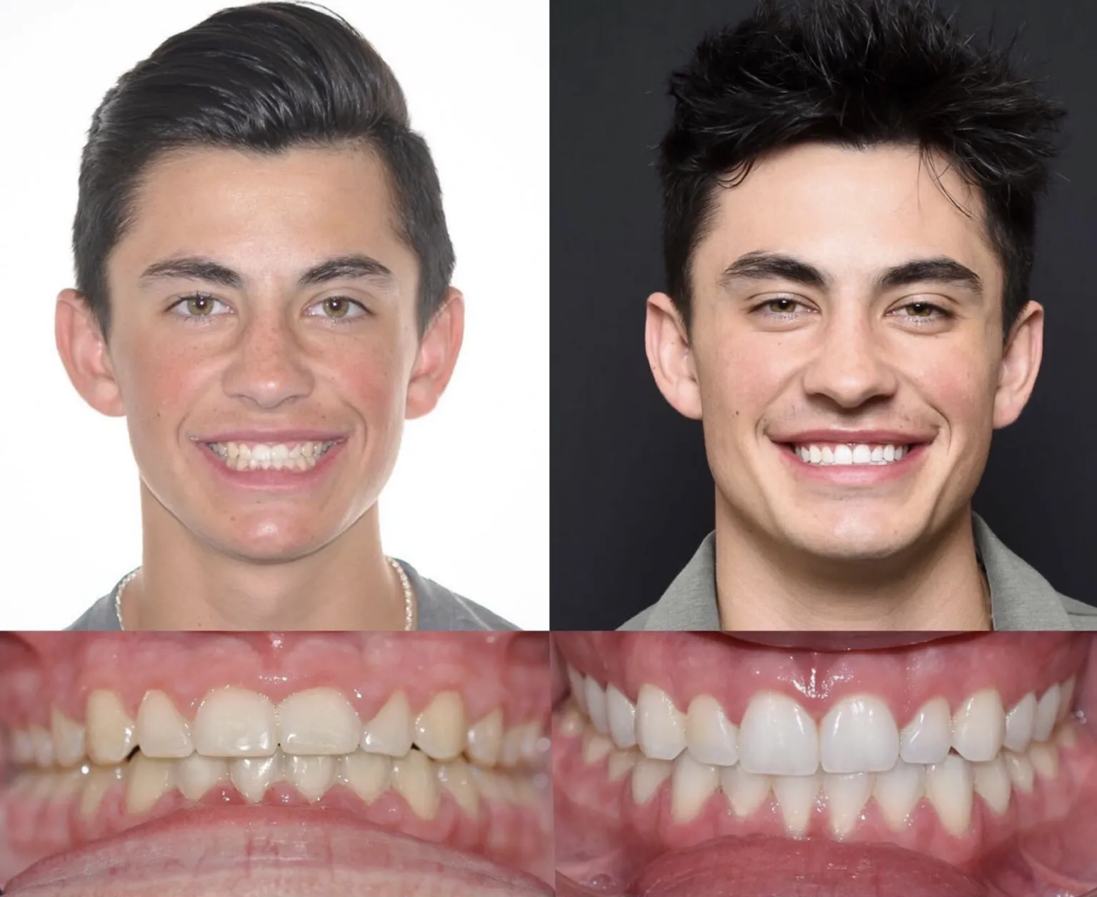 Young Adult Man Orthodontics Before and after