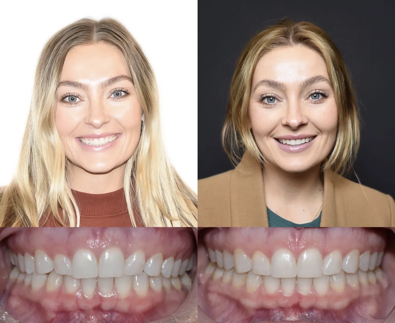 Young Adult Orthodontics Before and after