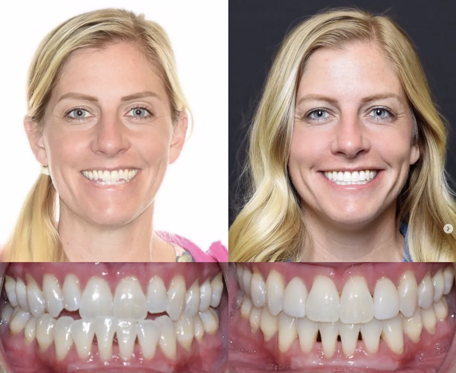 Adult Woman Orthodontics Before and after