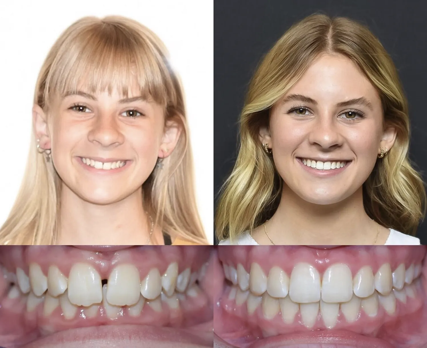 Teen Girl Orthodontics Before and after