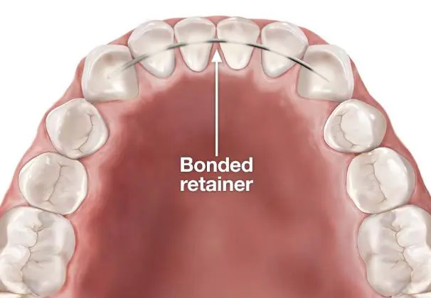 Orthodontic Retainers in Centerville UT